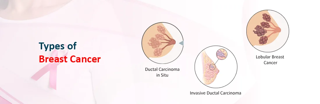 Types of Breast Cancer